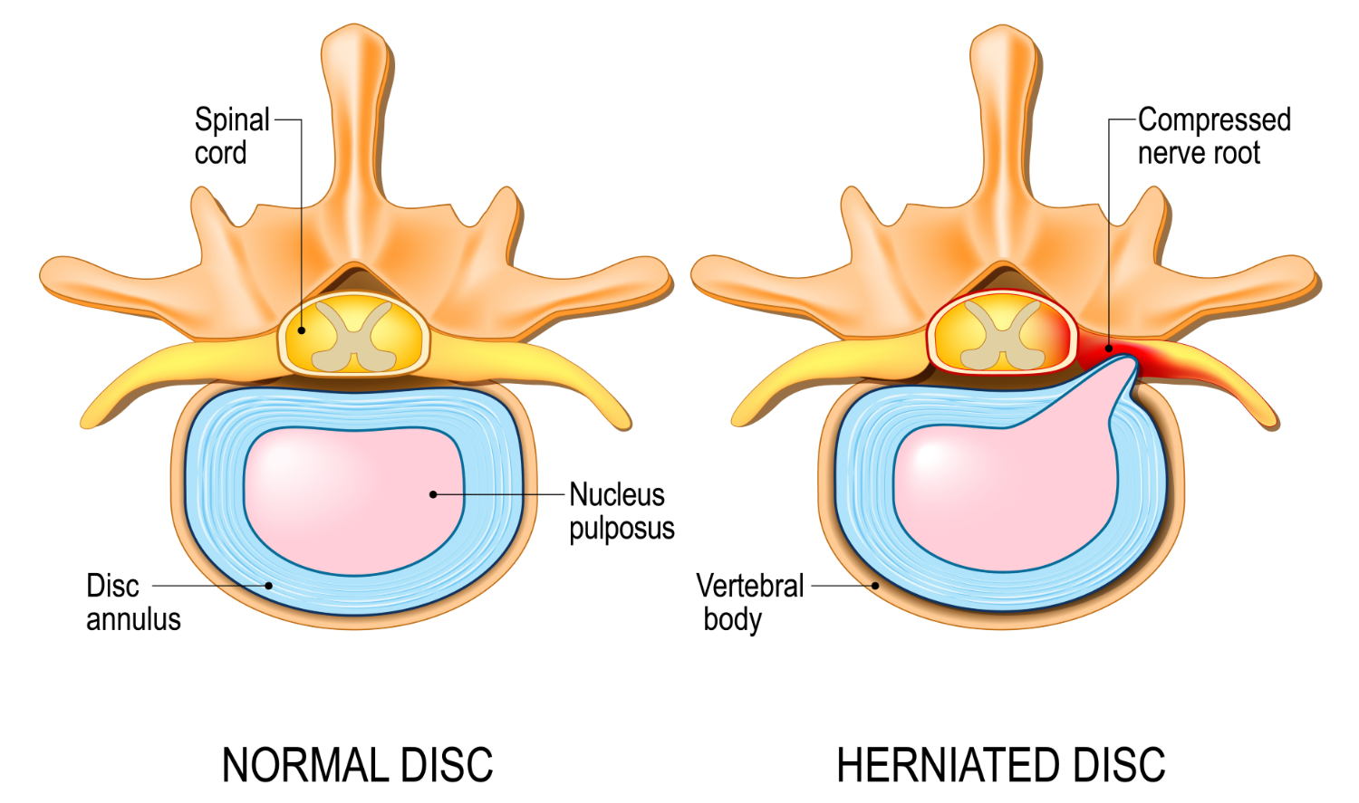 herniated disc