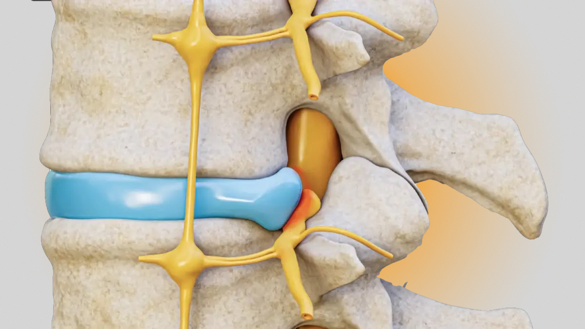 prolapsed disc illustration