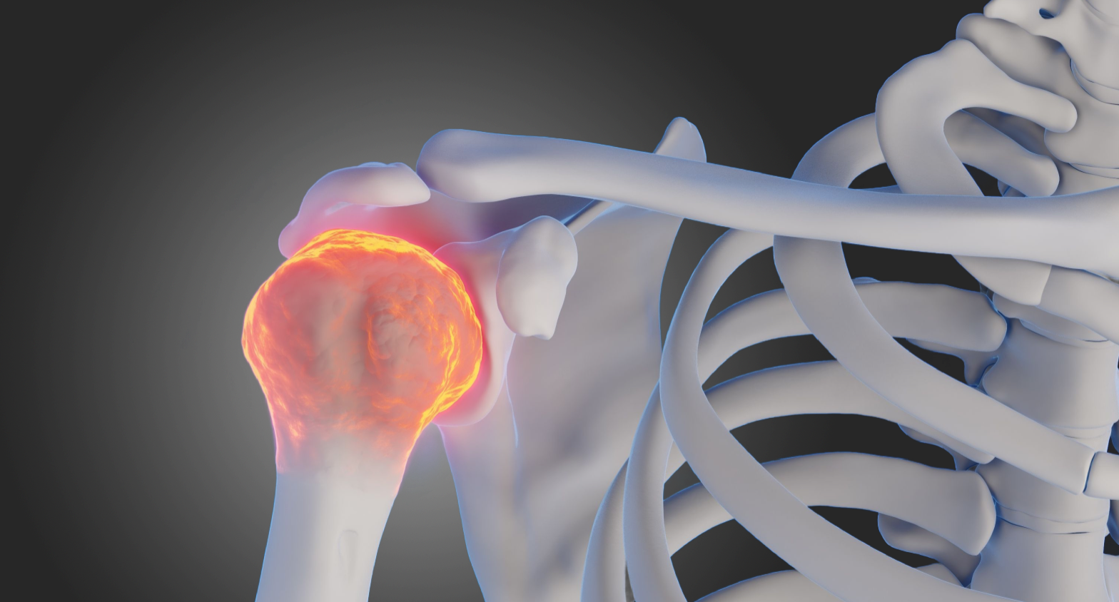 inflammed frozen shoulder