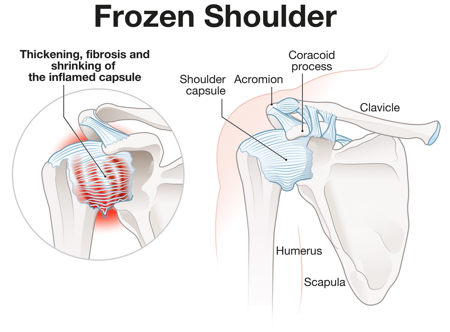 frozen shoulder diagram